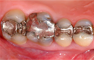 Chữa sâu răng cấm bằng công nghệ nào hiệu quả