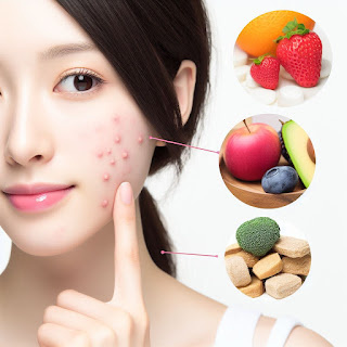A woman having acne-free skin with nutritional tips