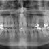 Abscessed Teeth