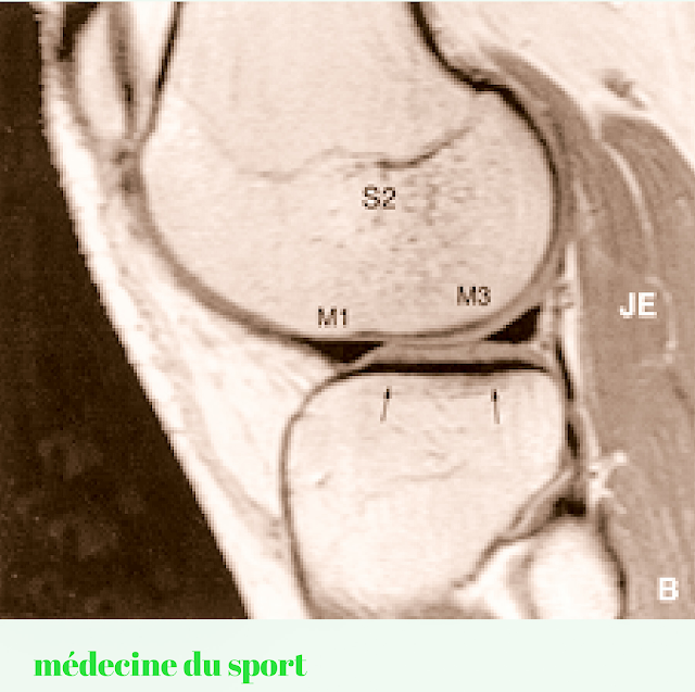 IMAGERIE DU GENOU APPLIQUÉE A LA PATHOLOGIE SPORTIVE