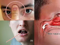 Cara Menghilangkan Hidung Tersumbat Pada Anak