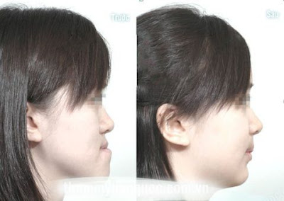 Nhiều người thắc mắc chỉnh răng làm thay đổi khuôn mặt 2