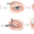 Thẩm mỹ sụp mí mắt tái tạo đôi mắt đẹp tươi trẻ