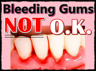 দাঁতৰ আলুৰপৰা তেজ কিয় উলায়? অন্য কোনো ৰোগৰ সংকেত নহয়টো! What is bleeding gums a sign of?-in assamese