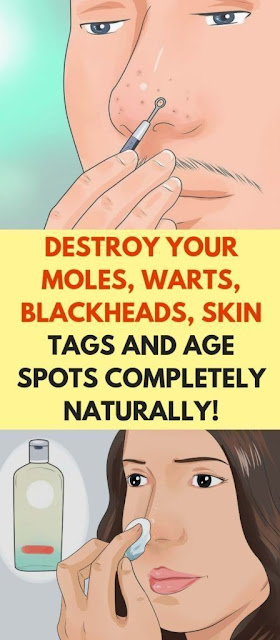 Destroy Your Moles, Warts, Blackheads, Skin Tags & Age Spots Completely Naturally!!!