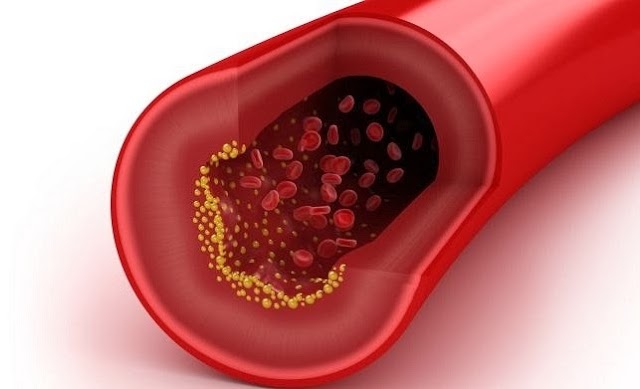Petua Mengurangkan Kolestrol Dalam Darah
