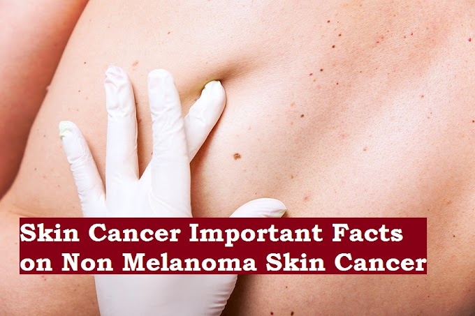 Skin Cancer Important Facts on Non Melanoma Skin Cancer