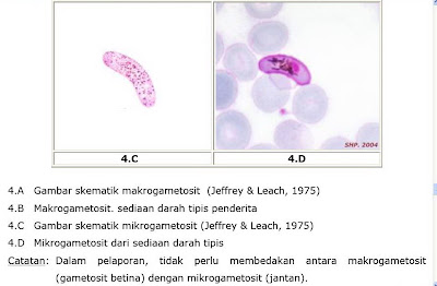 Gambar mikroskopis, Pewarnaan giemsa, sediaan darah tips, Plasmodium Falciparum Malaria