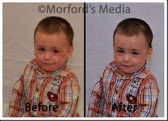 Josiah exzema before and after