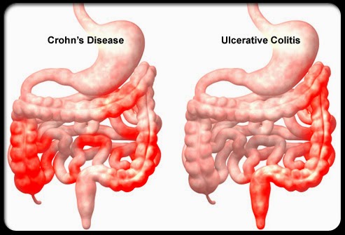 Crohns Disease S5 Illustration Of Crohns Disease And Ulcerative