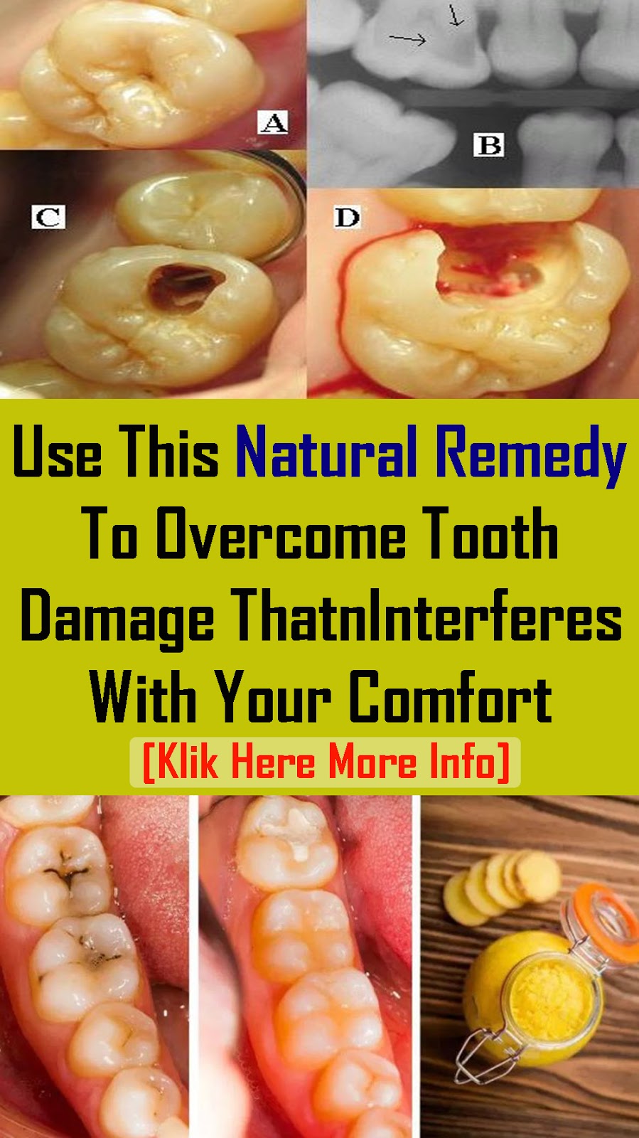 TRY THIS NATURAL REMEDY IT WILL HELP YOU TO TREAT TOOTH