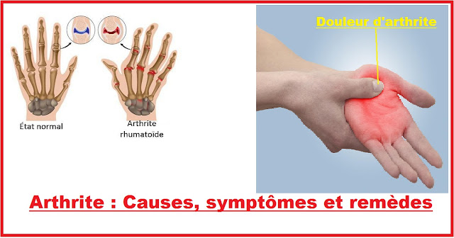 Arthrite : Causes, symptômes et remèdes