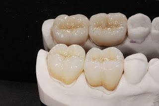 Quy trình trám răng tại nha khoa-1