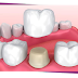 Có nên bọc sứ cho răng bị mẻ?