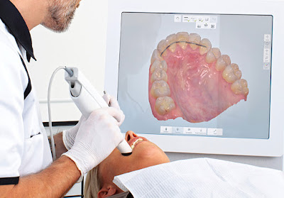 benefits of intra oral scanner