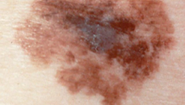 malignes melanom Durchmesser frühstadium bilder
