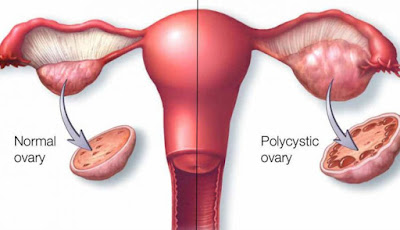 http://www.mathrutva.in/pcos.html