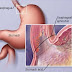 Gastritis - Imbalanced Nutrition Less Than Body Requirements