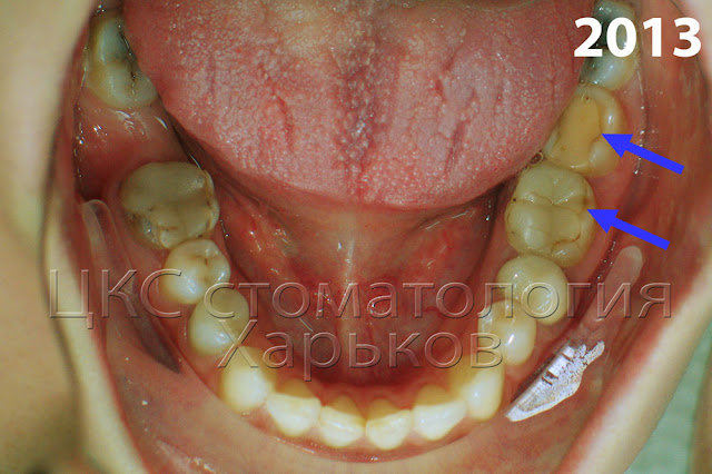 Нарушена связь между пломбой и тканями зуба