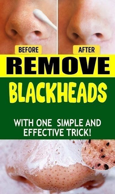 Remove Blackheads With One Simple And Effective Trick