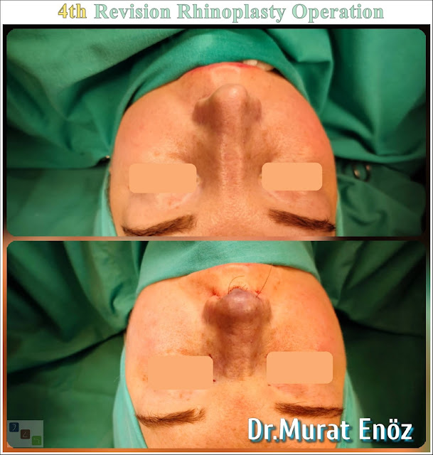 Fourth Revision Nose Job 4th Revision, Rhinoplasty Operation in Istanbul, Micromotor Assisted Revision Nose Aesthetic Surgery