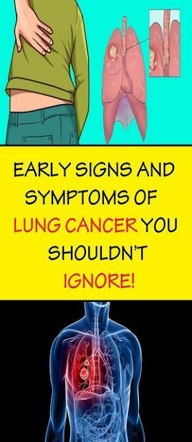 WATCH OUT: EARLY SIGNS AND SYMPTOMS OF LUNG CANCER YOU SHOULDN’T IGNORE!