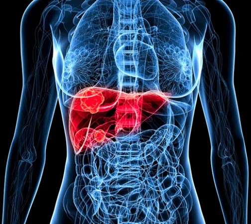 Gordura no fígado: sintomas que você não deve ignorar jamais