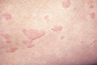 SAINTIS mendakwa ruam merah gatal pada kulit mungkin menjadi petanda baharu koronavirus (Covid-19) walaupun pesakit tidak mempunyai gejala biasa lain.