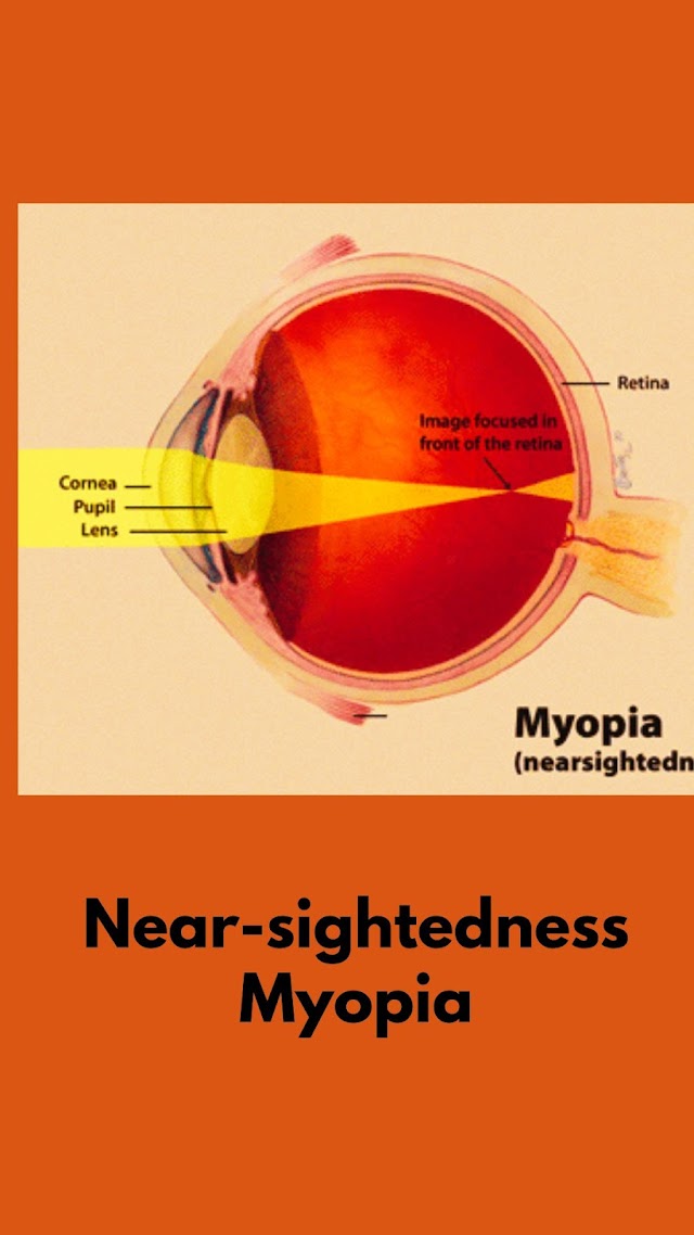 Understanding Nearsightedness Myopia | Causes Symptoms Treatment Options and Prevention