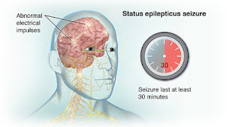 癲癇重積狀態治療 Status epilepticus, SE