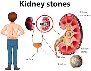 tablet for kidney stone