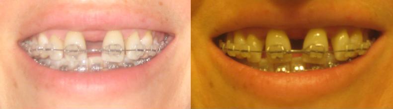 Day 1 braces------------------