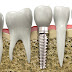 Ai nên cấy ghép implant?