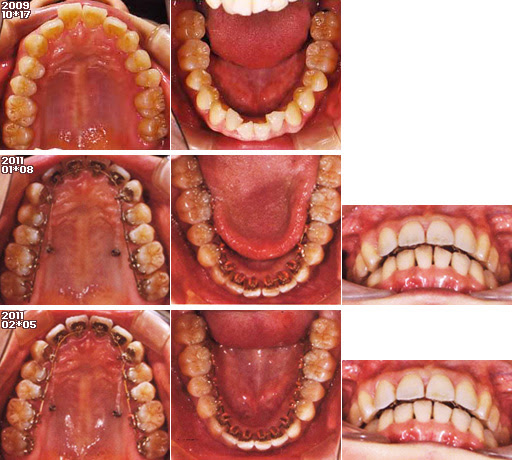 歯列矯正：定期検診その6