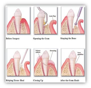  flap surgery