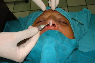 rinoplastia laser, rinoplastia lima , rinoplastia peru 