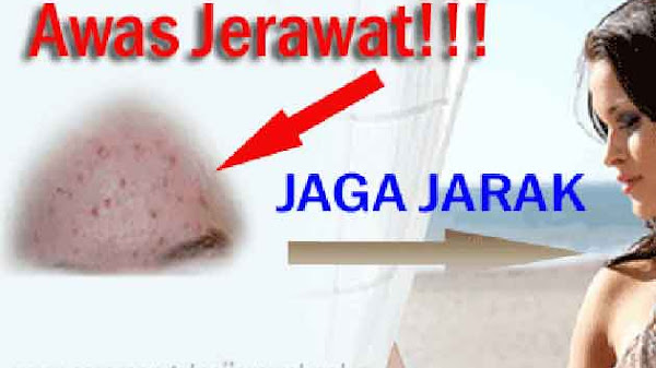 PENYEBAB TIMBUL DAN MUNCULNYA JERAWAT