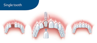 http://www.allonfourimplantsindia.com/single-tooth-treatments-and-advantages.html