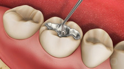 Trám răng có mấy loại?