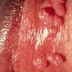 Obat kutil kelamin di jakarta thumbnail