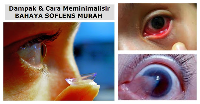 Hati - Hati,, Ada Bahaya Mengintai Dibalik SOFTLENS MURAH .. Masih Mau Pakai ?? Simak Dampak & Cara Menghindarinya