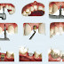 Kỹ thuật implant an toàn, hiệu quả