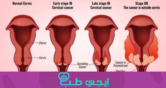 سرطان المهبل