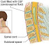 What is Myelomalacia - Definition, Symptoms, Causes, Treatment