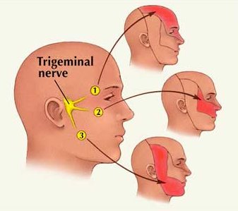 إلتهاب العصب الخامس .. أسباب وعلاج