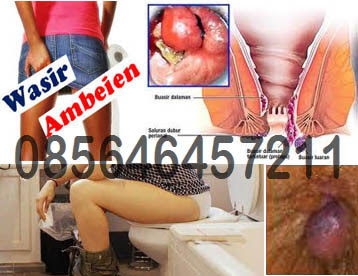 Obat Wasir (Hemoroid) Ambejoss Terpercaya