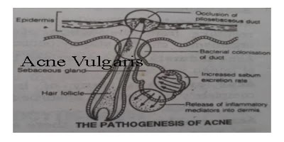 Acne Vulgaris