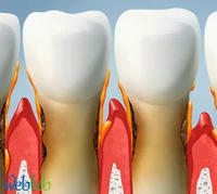 All you want to know about the treatment of inflamed gums!