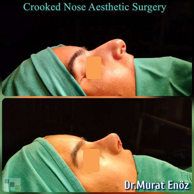 Rhinoplasty Operation For Crooked Nose,Crooked Nose Aesthetic Surgery For Female,Twisted Nose Rhinoplasty,