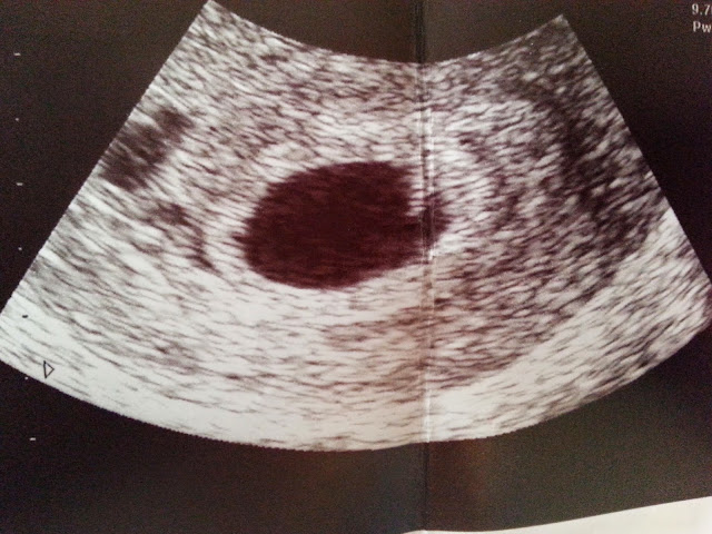 An early pregnancy scan